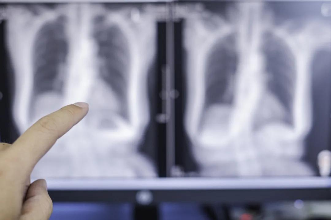 老公拍胸片影响备孕吗(怀孕做胸透怎么补救）
