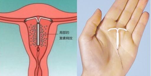 节育环为什么能避孕(夫妻长期避孕最好方法）