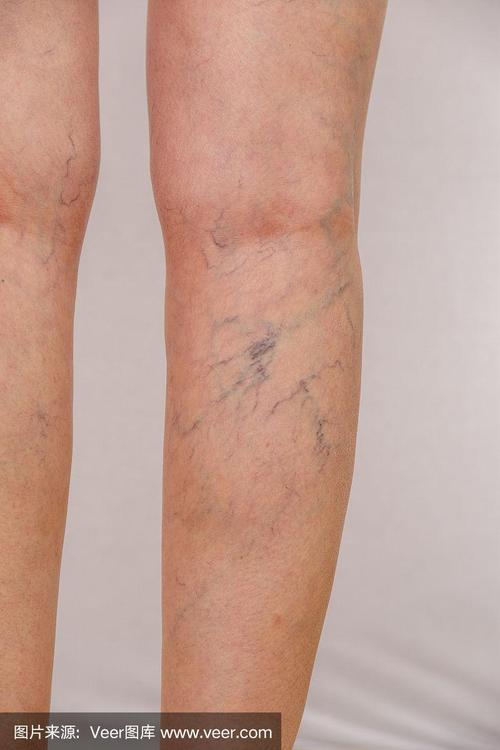 前列腺钙化影响怀孕吗前列腺钙化不能生孩子吗？(前列腺钙化怎样能消失）