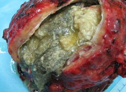 做畸胎瘤手术最佳时期(畸胎瘤怎么判断是良性）