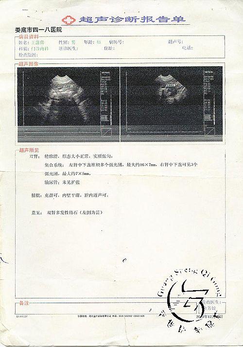 节育环下移的诊断标准(环下移b超诊断标准）