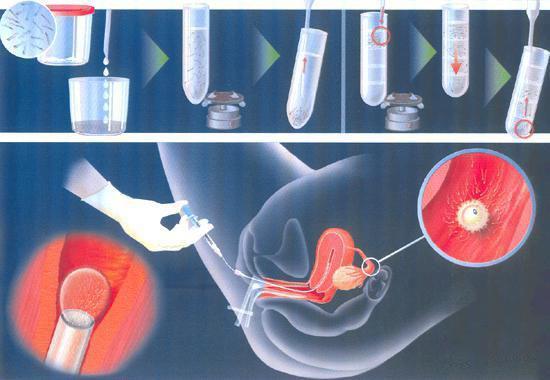 什么样的夫妻适合人工授精人工授精的孩子正常吗(男女都正常做人工授精成功率多少）