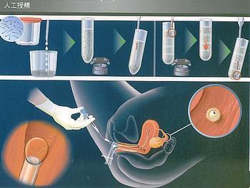 人工授精还是试管疼(试管婴儿取卵时疼吗）