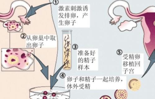 人工受孕5大副作用(人工受孕和试管婴儿）