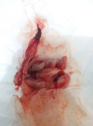 人流十次多还会怀孕吗(做过十次人流还能再做吧）