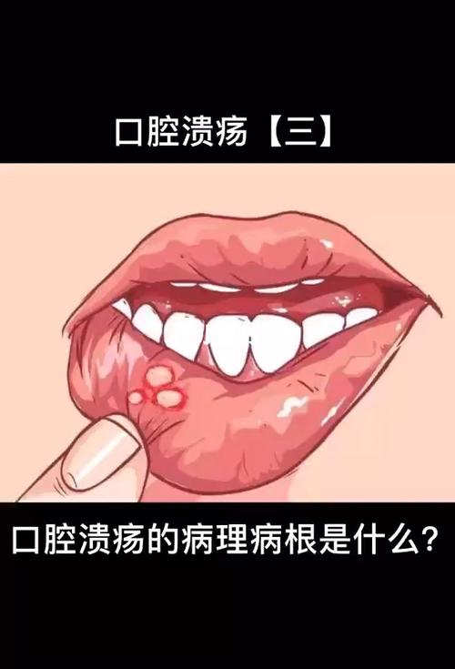 口腔溃疡可以喝奶茶吗(嘴总是溃疡怎么回事）