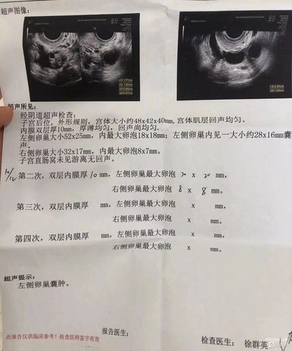 卵泡会变成囊肿吗(卵泡囊肿多久能消下去）
