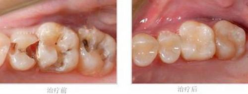 补牙后多久怀孕好(孕妇补牙窟窿简单处理)