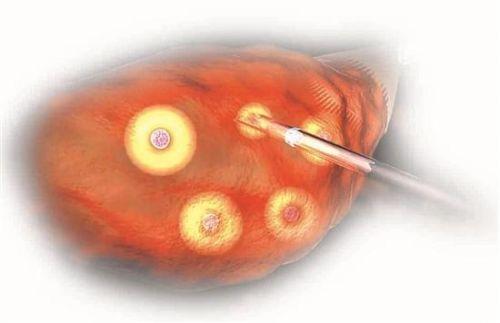 取卵前可以同房吗同房对卵子会有影响吗？(试管婴儿步骤取卵疼吗）