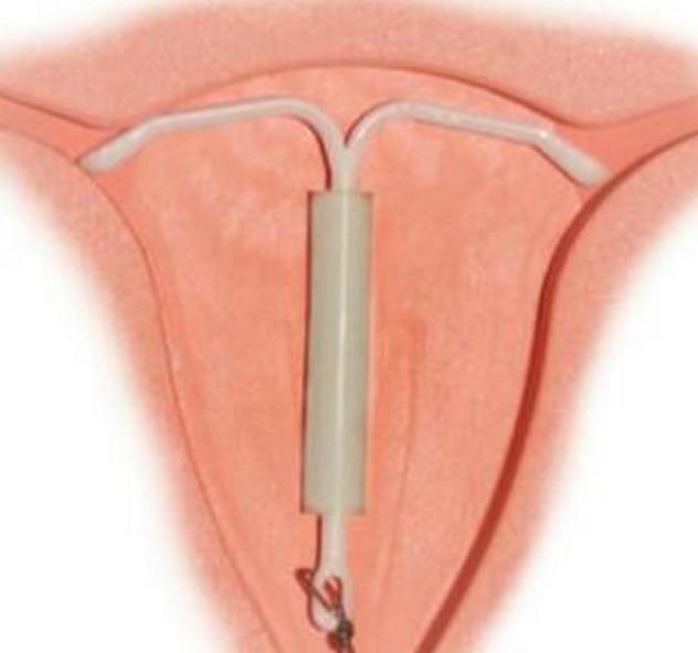 避孕套和上环哪个安全呢(上环还要带避孕套吗）