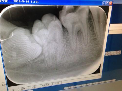补牙拍片多久可以怀孕(补牙打了麻药多久可以怀孕）