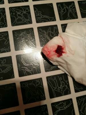 例假血块排出像猪肝正常吗(恶露排出猪肝状大块）