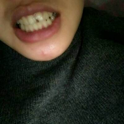 补牙当月可以怀孕吗(老公在备孕期间补牙有影响吗）