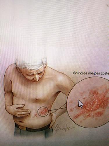 单纯疱疹多久可以怀孕(得了疱疹能生孩子吗）