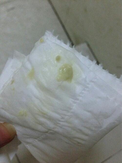 分泌物像豆腐渣是怎么回事(下面很痒还有像豆腐渣什么原因)