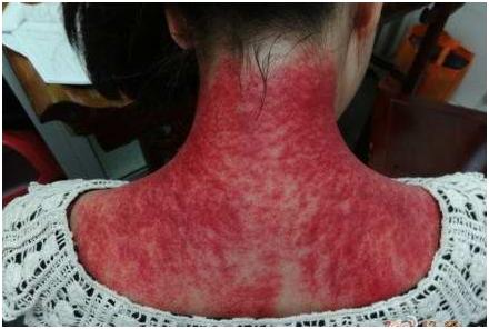 刮痧对怀孕有影响吗(怀孕刮痧对孩子的影响是什么）