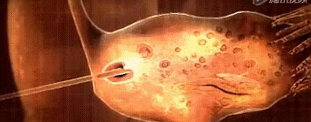 发烧会影响受孕卵的正常吗(打了破卵针会不会发烧)