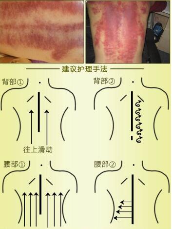 刮痧对怀孕有影响吗(怀孕刮痧对孩子的影响是什么）