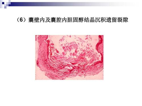 右侧附件囊肿是什么原因造成的(右侧附件囊肿怎么引起的）