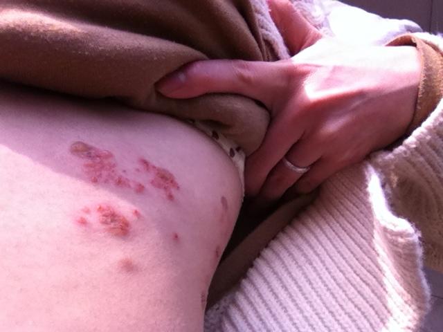 单纯疱疹多久可以怀孕(得了疱疹能生孩子吗）