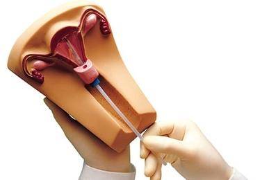 取环后可以2个月受孕吗(取环后为何不孕）