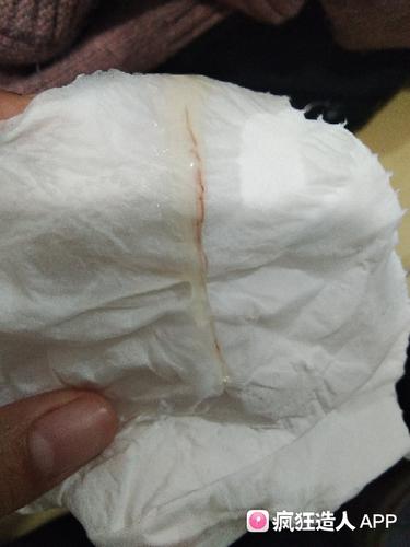 分泌物有血丝怎么回事(白带里有轻微血丝是怎么回事)