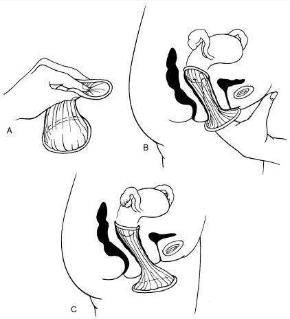 避孕套戴反了可以吗(避孕套反过来还避孕吗）
