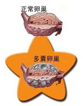 卵巢多囊样改变需要治疗治疗吗卵巢保养吃什么好(双侧卵巢多囊样改变怎么治疗好）