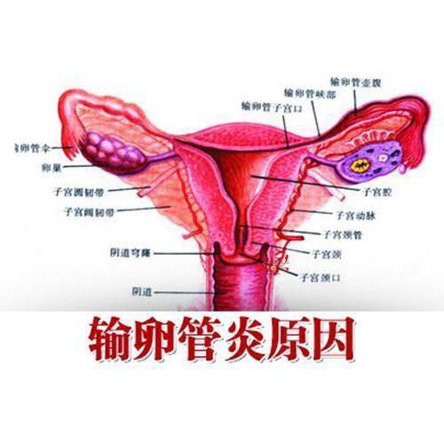 双侧输卵管炎如何治疗(输卵管炎症状）