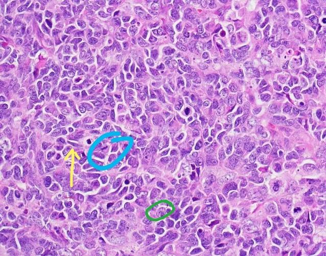 双髋置换后可以怀孕吗(双侧髋关节置换后能和正常人一样么)