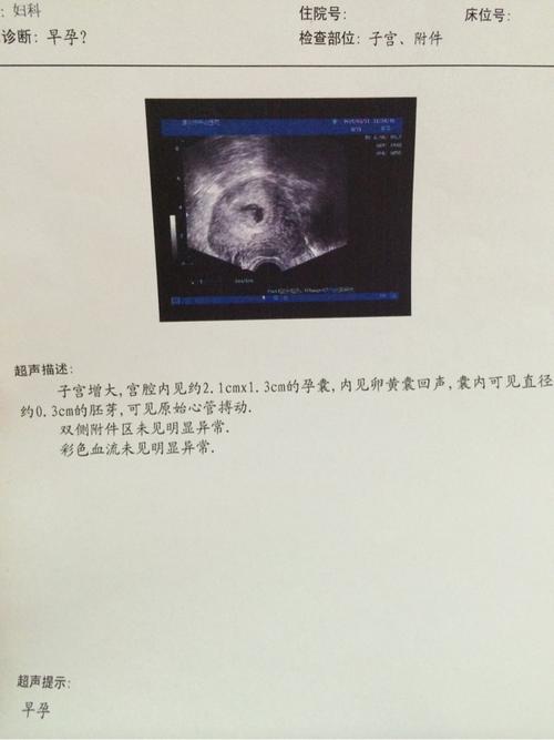 同房18天能看到孕囊吗(实际受孕18天可以看见孕囊吗）