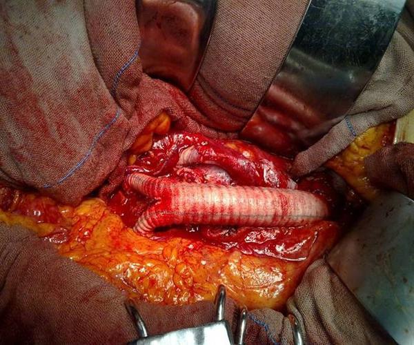 为什么剖腹产后不孕了(宫腹腔镜手术通输卵管多少钱）