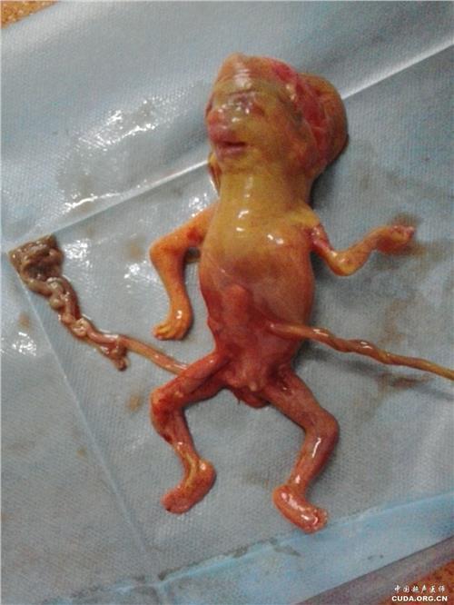 以前引产过影响怀孕吗(月经推迟跟怀孕的区别）