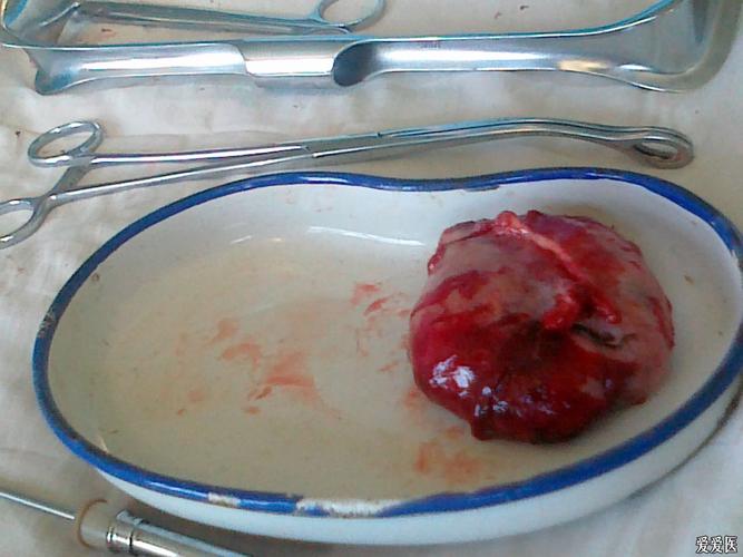 卵巢畸形瘤忌讳什么(畸胎瘤怕什么)