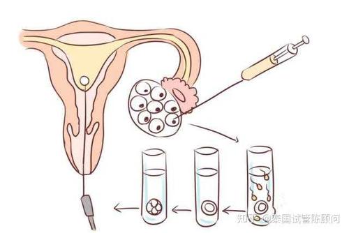 取卵后几天可以运动(女人取卵后给带来的伤害）