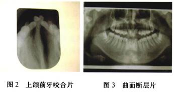 卵巢过度刺激综合征怎么治疗(怀孕双侧卵巢增大正常吗）