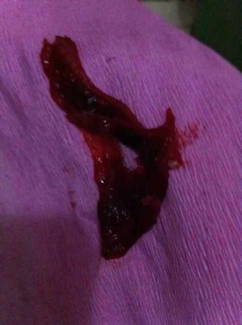 刮宫后月经不走怎么办(做完刮宫术后来月经流血不停）