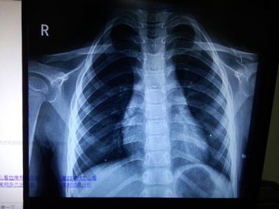 老公拍胸片影响备孕吗(怀孕做胸透怎么补救）