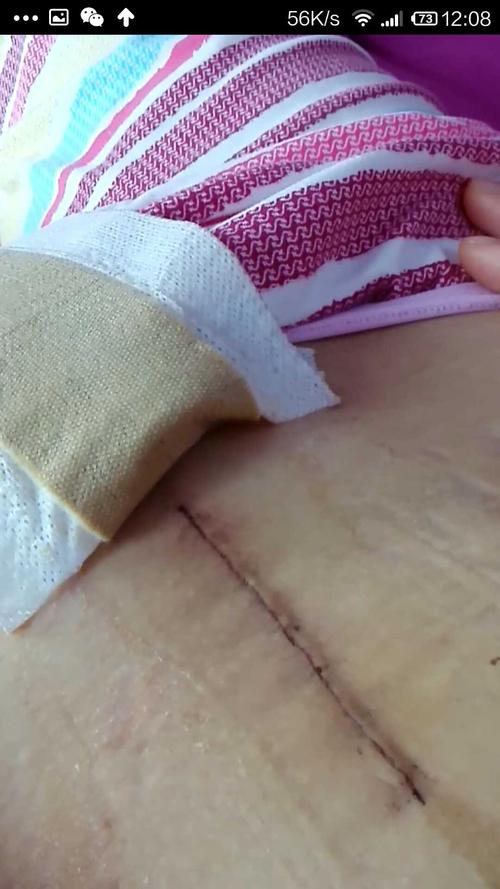 剖腹产后多久可以怀孕(剖宫产1年又怀孕了)