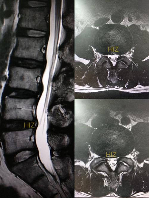 产后阴道壁膨出，还能生二孩吗？(二胎前壁膨出严重可以吗）