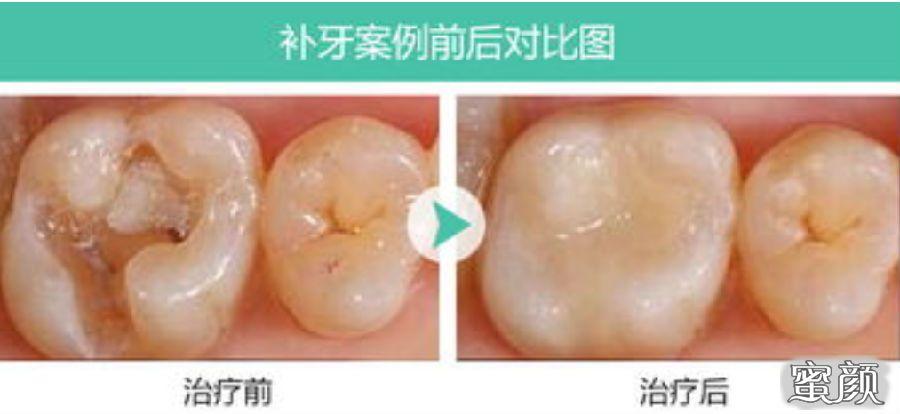 补牙多久可以怀孕(备孕前一定要补蛀牙吗）