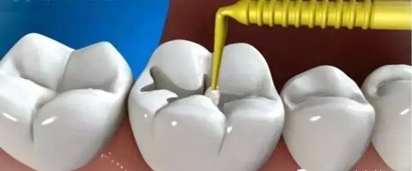 补完牙多久可以怀孕(去补牙要注意什么套路）