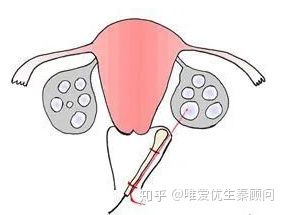 取卵后几天可以运动(女人取卵后给带来的伤害）