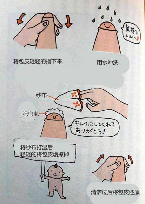 包茎嵌顿自己能好吗(能翻出来但嵌顿）