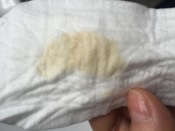 褐色的白带如何调理(黑褐色分泌物怎么回事没来月经）