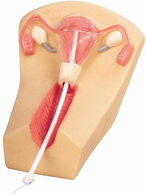 什么是避孕器(子宫内避孕器）