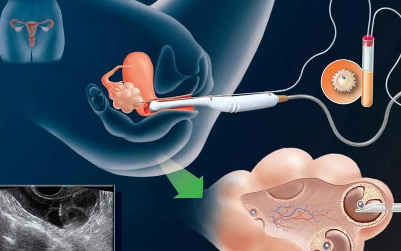 取卵对女性的伤害大吗女性朋友们一定要看！(多次取卵对身体的伤害）
