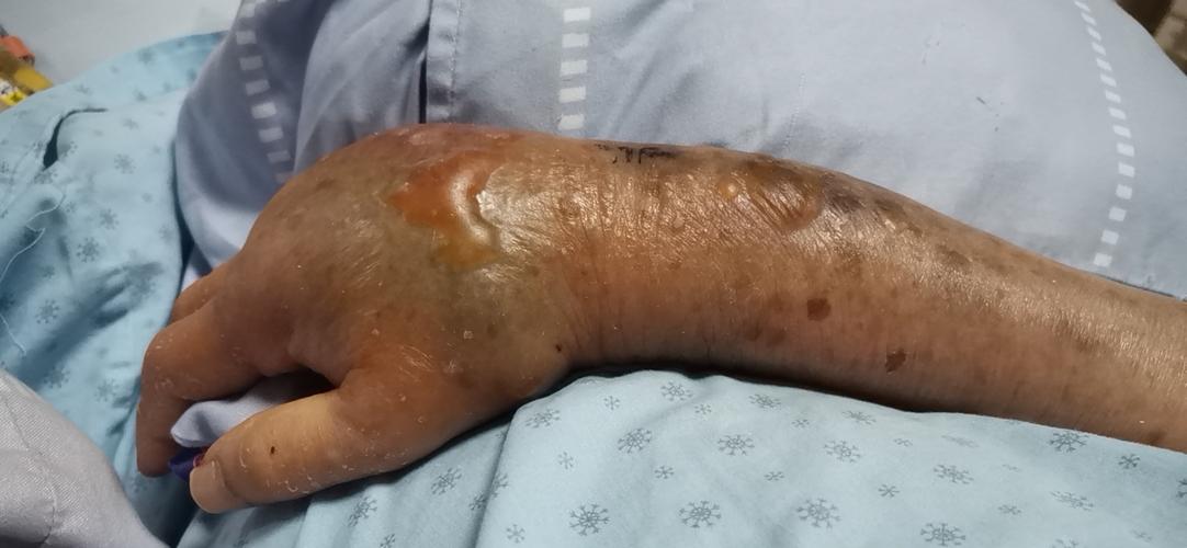 六个常见原因引起女人脱发(上消化道出血最常见的原因)