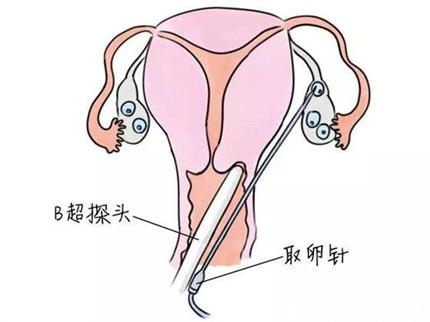 取卵要空腹吗取卵不能吃东西吗?(取卵后可以吃东西吗)