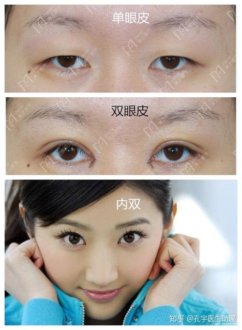 双眼皮的父母会生出单眼皮的孩子吗?(2个单眼皮生出双眼皮)